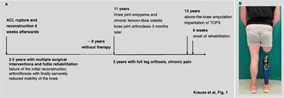 Elective transfemoral amputation and simultaneous implantation of a transcutaneous osseointegrated prosthesis stem as salvage treatment after knee joint arthrodesis with poor function: A case report